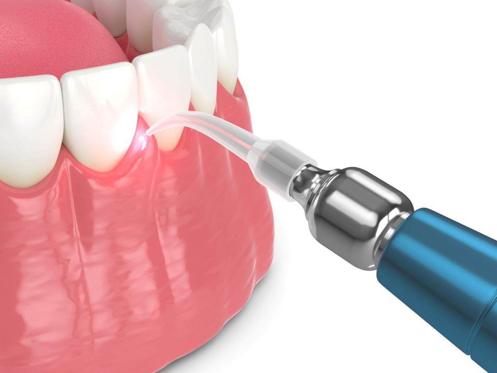 LANAP Laser Treatment Laser Periodontal Surgery LANAP Procedure